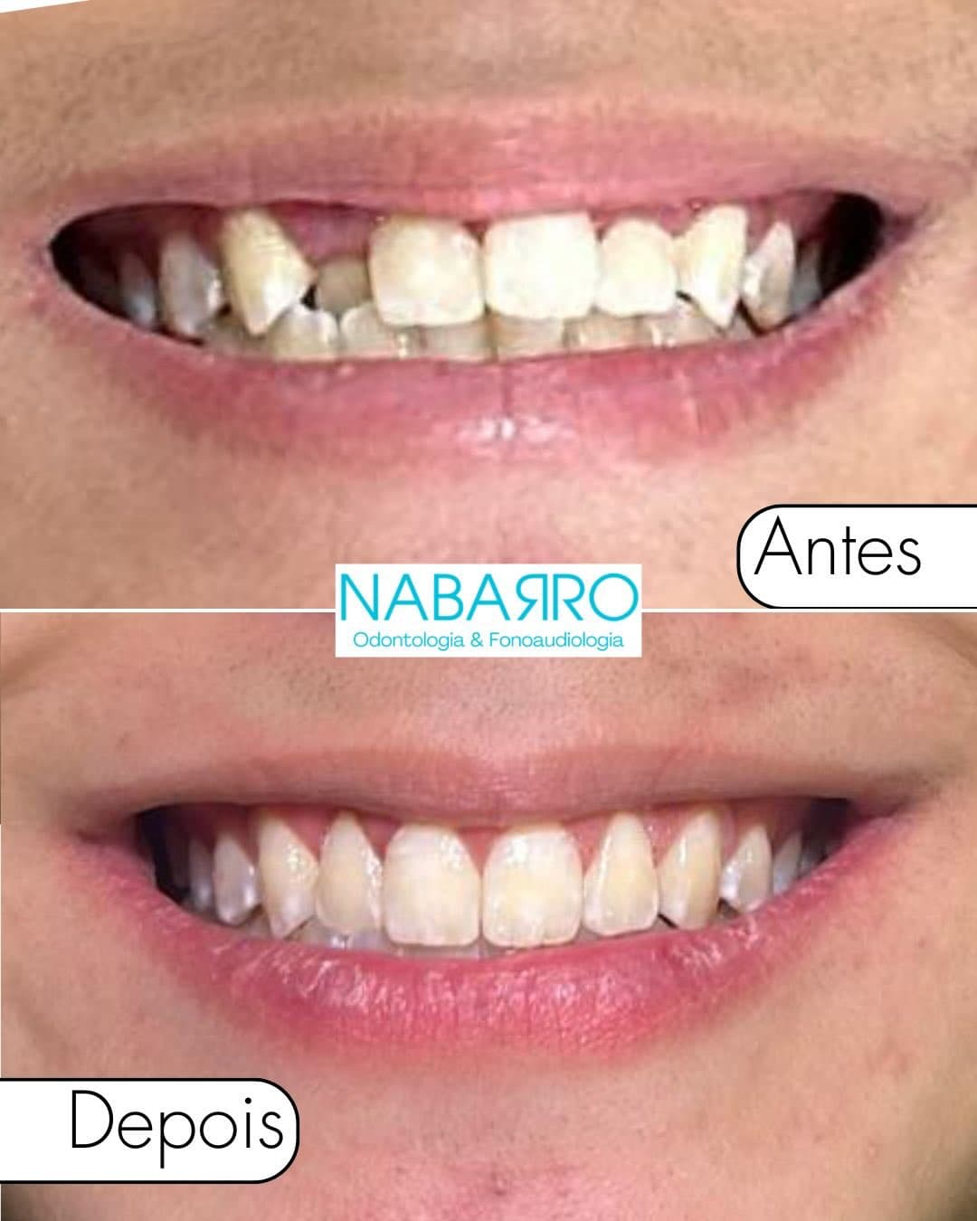 Depois — Resultado real